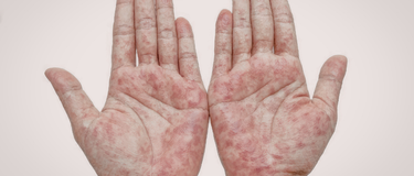 Homeopathy in paediatric atopic diseases
