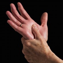 Arthritis-hand